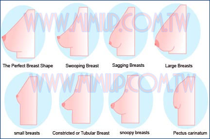 隆乳胸型分類