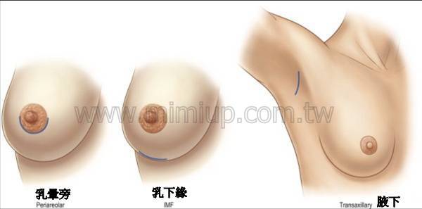 乳暈旁, 腋下, 乳下緣是最常用的隆乳切口