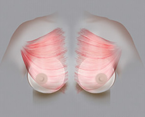 雙面複合式隆乳