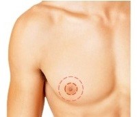 乳暈環形切口(periaveolar) 平胸手術